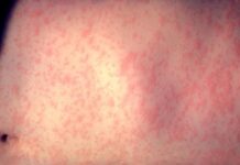 HEALTH WARNING: Traveller infected with measles visited Alice Springs